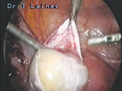 Removal of a dermoid cyst with laser laparoscopic surgery (laparoscopic image).